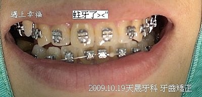 02 2009.10.19天晟牙科 牙齒矯正.j