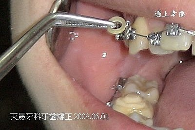 0601-2009牙齒矯正2.jpg
