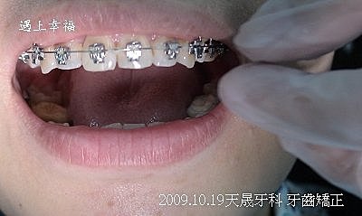 01 2009.10.19天晟牙科 牙齒矯正.j