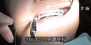 01牙齒矯正 結紮線.jpg