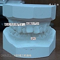 20090513我的矯正前齒模1.jpg