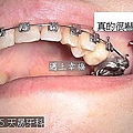 13 牙齒矯正打骨釘.jpg