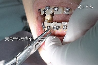 7牙齒矯正天晟牙科.jpg
