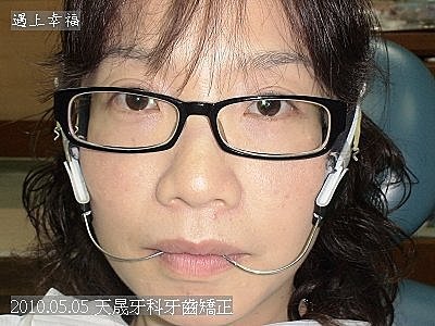 08 2010.05.05 天晟牙科牙齒矯正.j