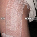 02-2012.03.25 Q比開刀疤痕處理01.