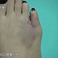 20100623腳趾受傷04.jpg