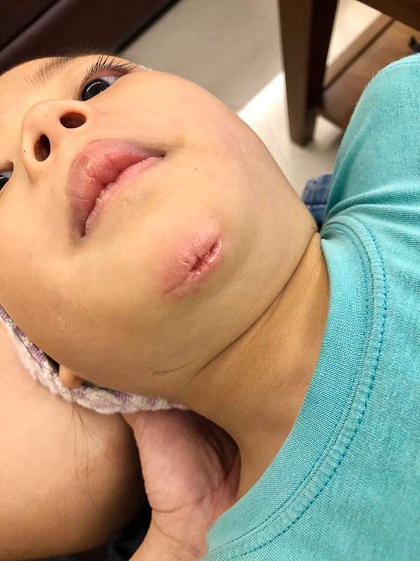 膽小勿看 受傷縫合只能 急診 處理嗎 媽媽心疼分享 我是愛花成癡的彩妝師calia 甜炘 痞客邦