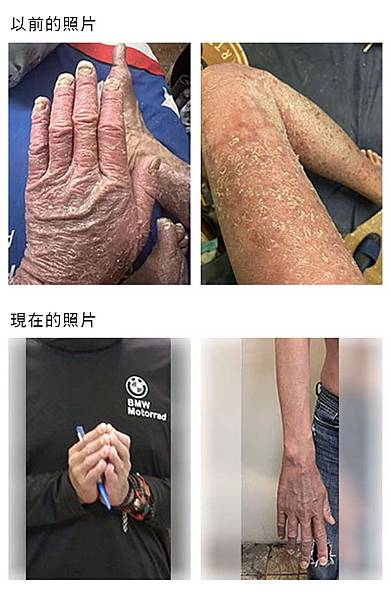 乾癬頑疾終於痊癒了