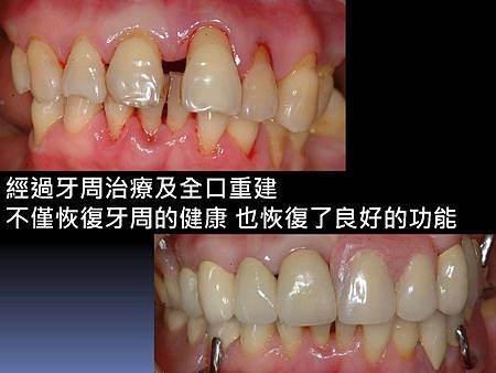 牙周病造成牙齒位移 