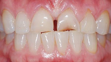 如果是长期的夜间磨牙, 会造成牙齿的磨耗, 使得牙齿变得又平又短.