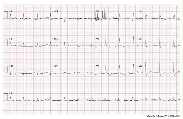ECG LBBB no STE 002 fix with line