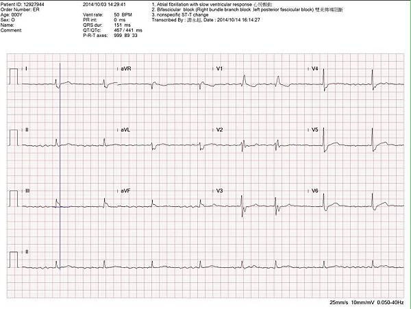 ECG RBBB no STE 002 fix with line