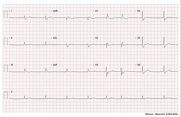 ECG RBBB no STE 002 fix