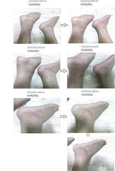腳水腫按原始點前後照-1014-1017