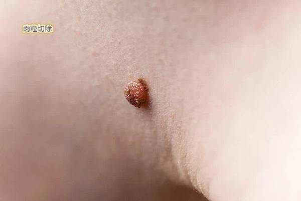 普遍息肉中哪一種最風險，這一發展趨勢成癌只需三年!