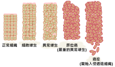 400px-Ch_cancer_progression.png