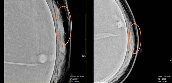 microcalcification1.jpg