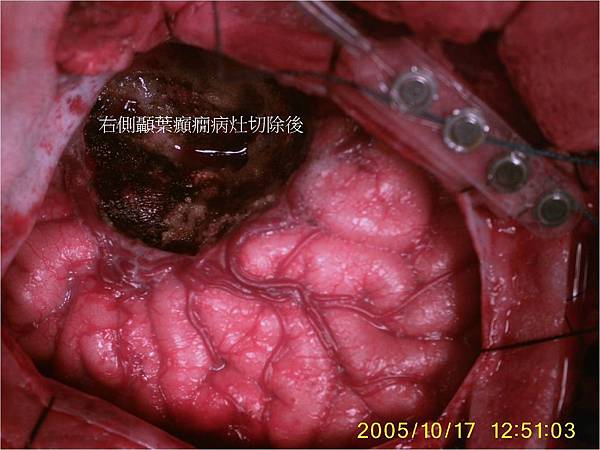 右側顳葉切除手術