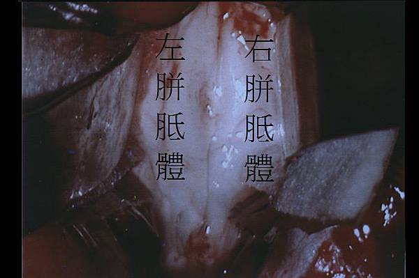 胼胝體切開手術中