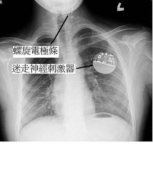 迷走神經刺激器植入手術後