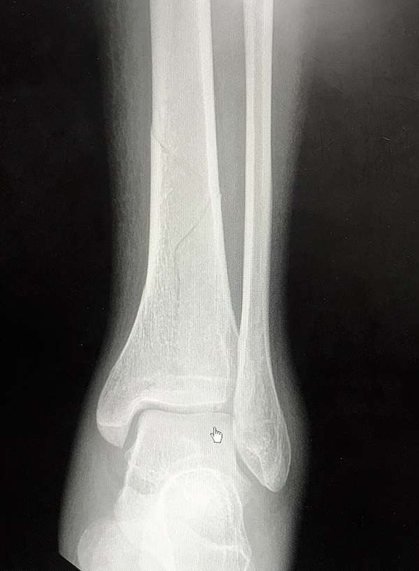 骨折康復紀錄qaq 左腿脛骨螺旋狀骨折 復健持續更新中 骨折紀錄 下 芽套星人 痞客邦