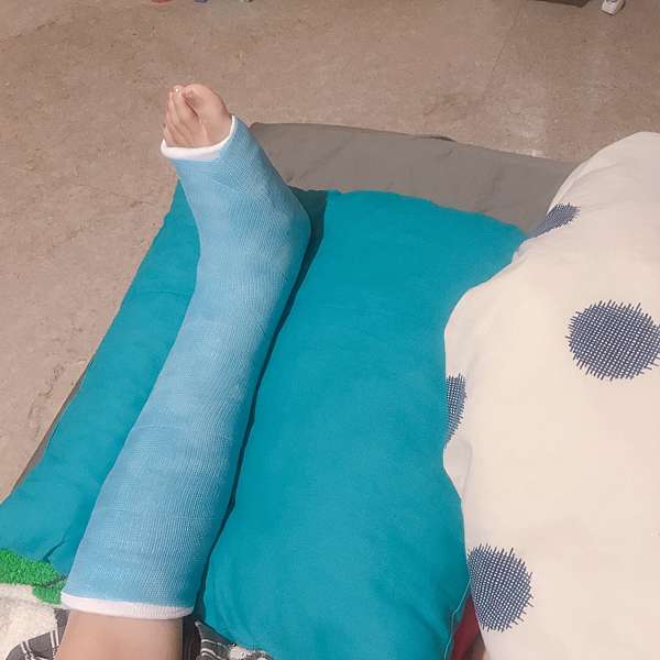 骨折康復紀錄qaq 左腿脛骨螺旋狀骨折 復健持續更新中 骨折紀錄 下 芽套星人 痞客邦 骨折康復紀錄qaq 左腿脛骨螺旋狀骨折 復健持續更新中 骨折紀錄 下 芽套星人 痞客邦