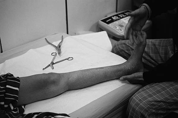 骨折康復紀錄qaq 左腿脛骨螺旋狀骨折 復健持續更新中 骨折紀錄 下 芽套星人 痞客邦 骨折康復紀錄qaq 左腿脛骨螺旋狀骨折 復健持續更新中 骨折紀錄 下 芽套星人 痞客邦