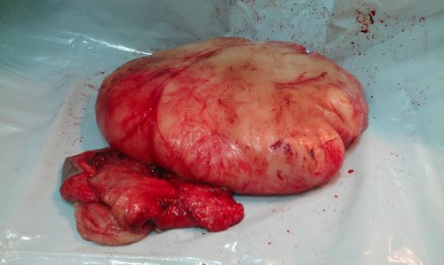 小脂肪瘤取出图片