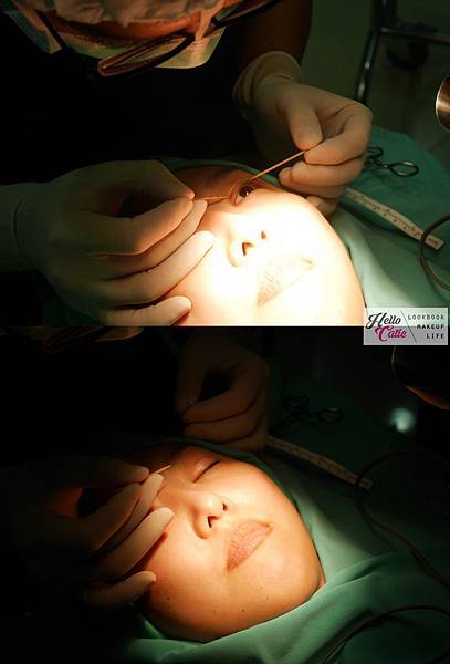 4D訂書針雙眼皮分享 - 超自然!!!! 4D訂書針縫雙眼皮 手術+術後一周滿意分享 杏立博全張至德醫師13.jpg