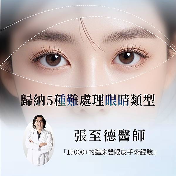 張至德醫師_雙眼皮手術.jpg