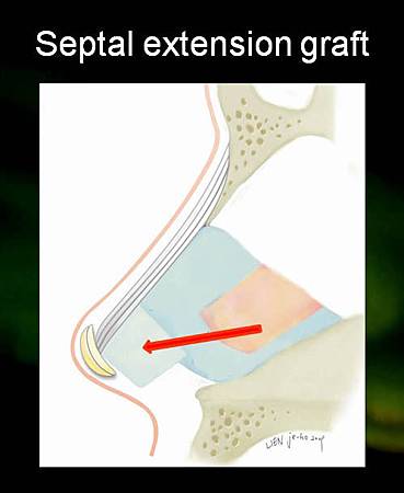 septal extension