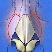 osteotomy