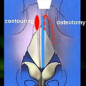 CT scan-