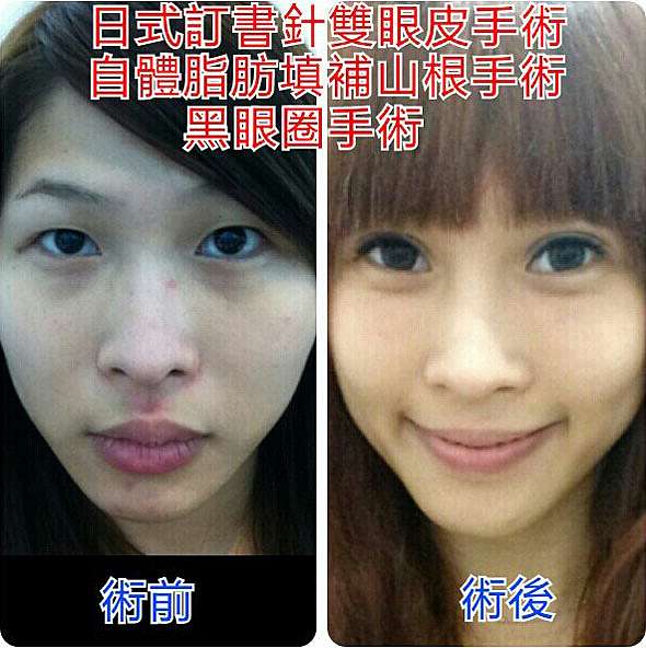 觀念大轉變 黑眼圈竟然是要用手術來治療的 車參聖 車醫師的個人部落格 痞客邦
