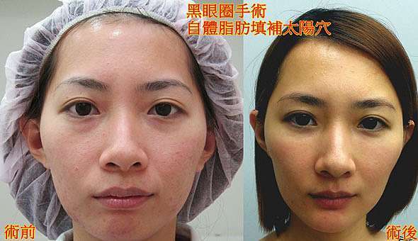 觀念大轉變 黑眼圈竟然是要用手術來治療的 車參聖 車醫師的個人部落格 痞客邦