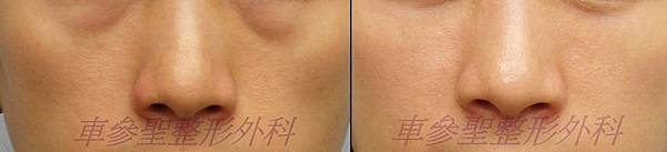 眼袋淚溝蘋果肌-黑眼圈手術 眼袋淚溝蘋果肌-黑眼圈手術