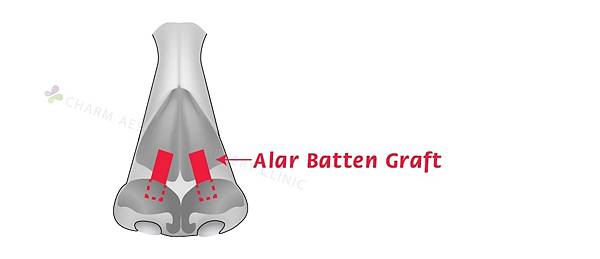 軟骨板條移植（batten graft).jpg