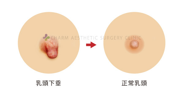 乳頭下垂(1).jpg