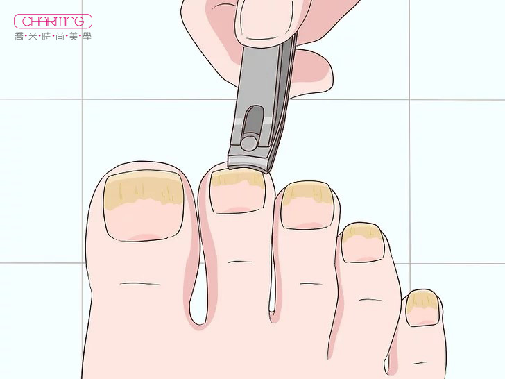 v4-728px-Treat-Toe-Nail-Fungus-Step-1-Version-4.jpg.jpg