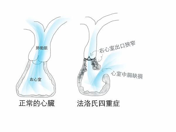 法洛氏四重症發紺的原因