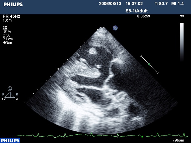 法洛氏四重症的心臟超音波影像 法洛氏四重症的心臟超音波:可見到明顯的主動脈跨位在心室中膈缺損上面