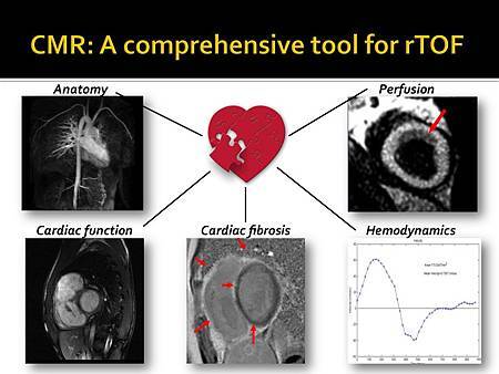 Cardiac MRI for rTOF_APSC2012 Cardiac MRI for rTOF_APSC2012