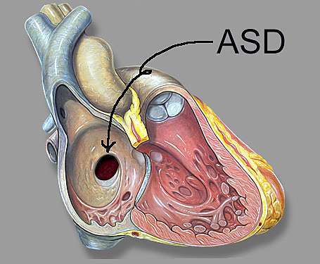 心房中膈缺損第二型 Atrial Septal Defect Type 2 Asd Ii 兒童心臟會客室 聊聊孩子們的心事 痞客邦 心房中膈缺損第二型 Atrial Septal Defect Type 2 Asd Ii 兒童心臟會客室 聊聊孩子們的心事 痞客邦