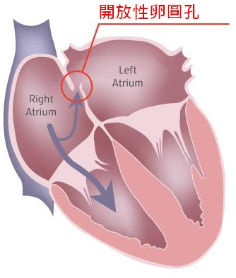 關閉卵圓孔能否預防 再次 發生不明原因的中風 兒童心臟會客室 聊聊孩子們的心事 痞客邦