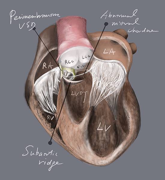 VSD SubAo ridge_6006666.jpg VSD SubAo ridge_6006666.jpg
