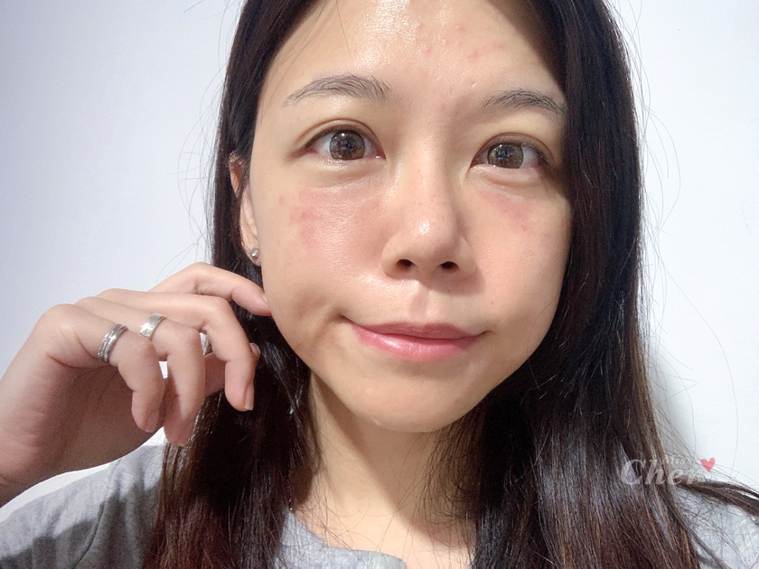 皮秒雷射體驗分享,皮秒雷射,皮秒,皮秒除斑,博恩妍