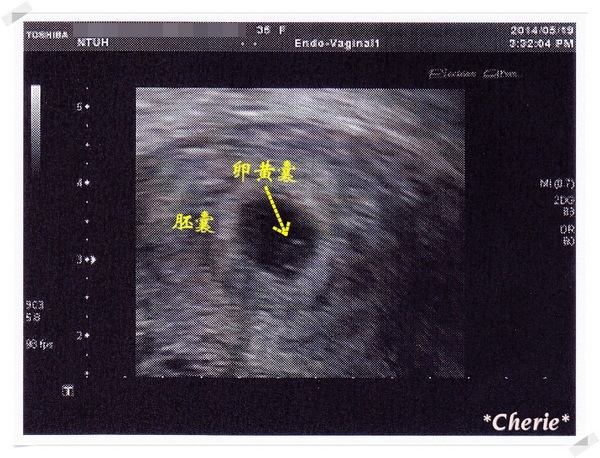 孕 初期 5w2d 與寶寶的第一次見面 Cherie 彩色棉花糖 痞客邦