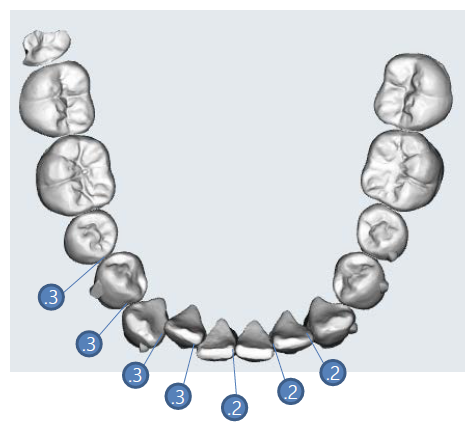 利用多顆牙齒鄰接面修磨 (interproximal reduction, IPR) 來得到排列空間