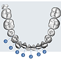 利用多顆牙齒鄰接面修磨 (interproximal reduction, IPR) 來得到排列空間