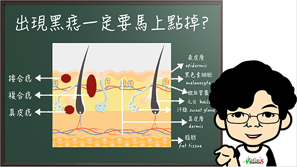 黑痣出現一定要馬上點掉？.png